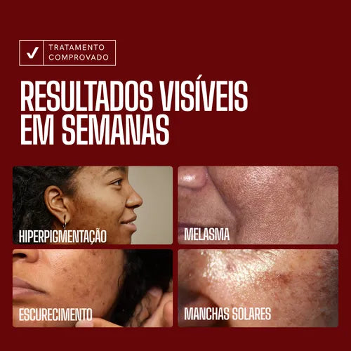 Envy Skin Tranexâmico Serum for Lightening Melasma Spots 30ml