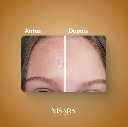 Creme Facial Visara Antiacne Ccontrole De Oleosidade - 50ml