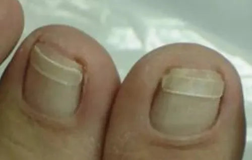 Ingrown Toenail Corrector Kit for Podiatrists Tape File Glue