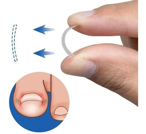 Ingrown Toenail Corrector Kit for Podiatrists Tape File Glue