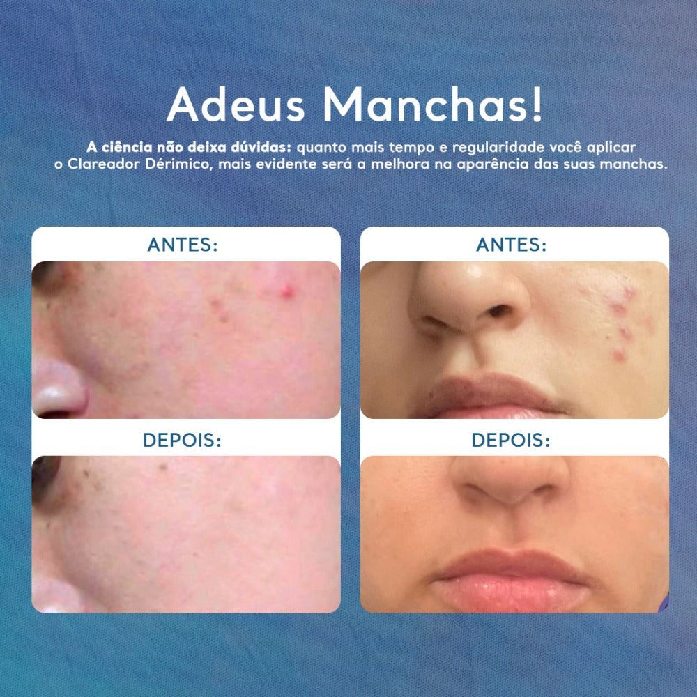 Creme Clareador de Manchas no Rosto e Corpo Clareador Dérmico - 60g
